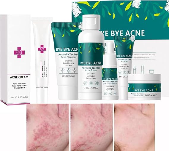 Acne Treatment for Face Skin Care Sets & Kits and Acne Cream Pimple Cream for Face